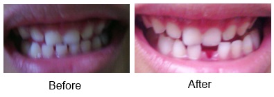 before-after cabut gigi
